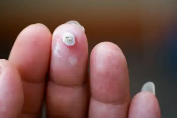 Image of white wart before cryopen treatment Felixstowe