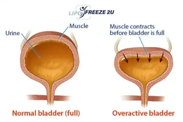 diagram of overactive bladder treatment Felixstowe