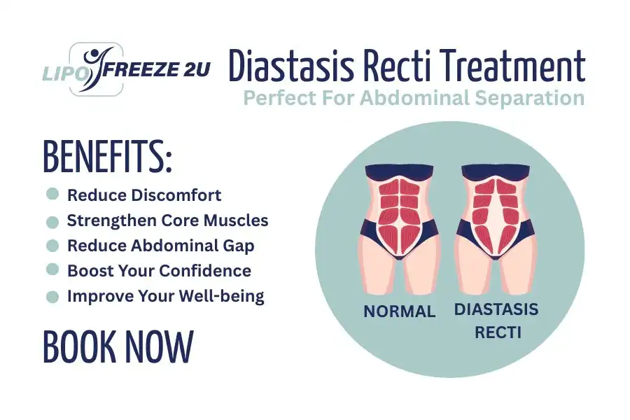Benefits of body toning treatment Felixstowe for Diastasis recti