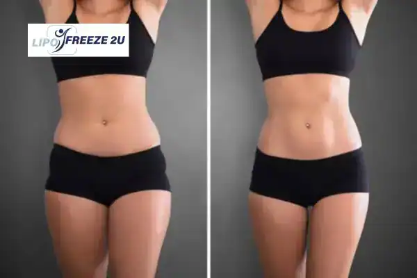 How Can LIPO FREEZE 2U Support Your Post-Pregnancy Body Recovery Felixstowe?