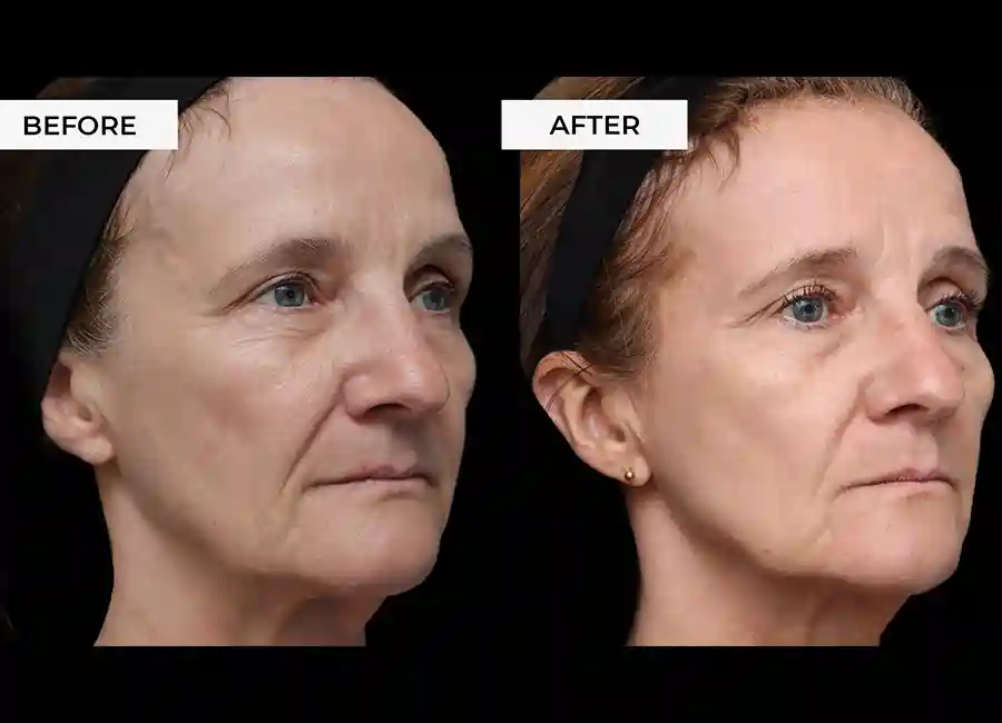 How Many RF Microneedling Sessions Will You Need to See a Difference Felixstowe?