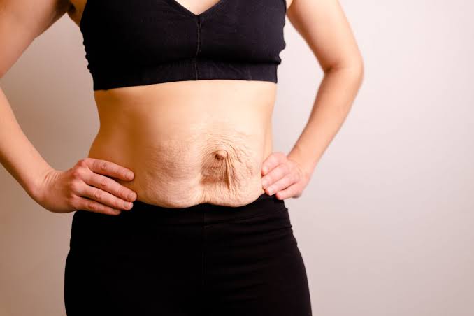 Is Surgery Really the Only Way to Repair Diastasis Recti Felixstowe?