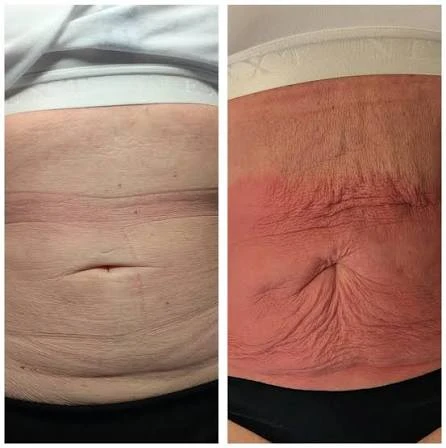 How Does RF Microneedling Improve Crepey, Thin and Uneven Skin Texture Felixstowe?