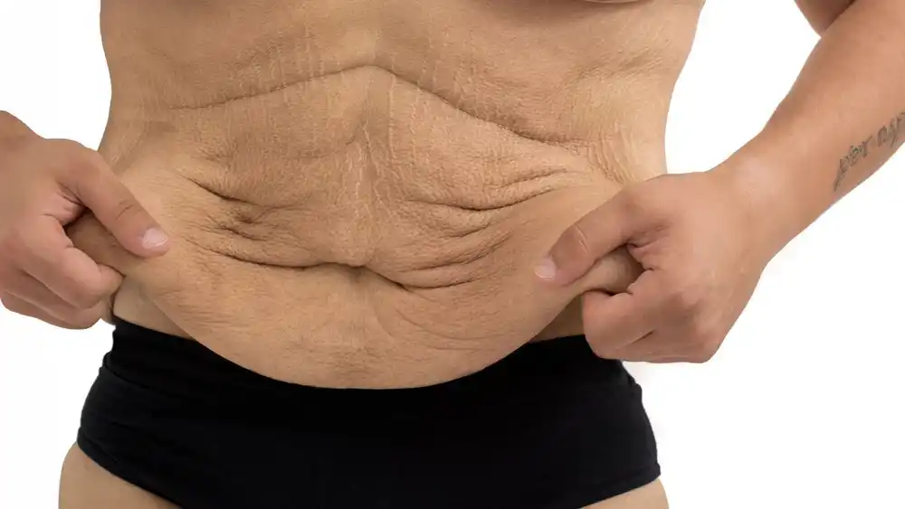RF Microneedling for Loose Skin: How Can It Help Tighten and Reshape the Skin Felixstowe?